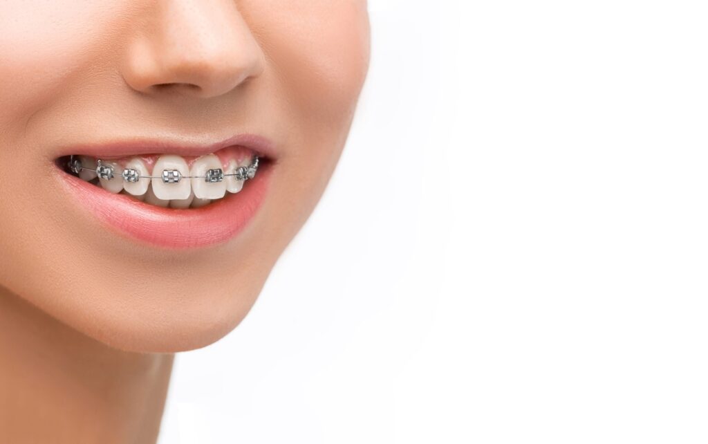 Embrace the Change: How Metal Braces Can Boost Your Confidence?