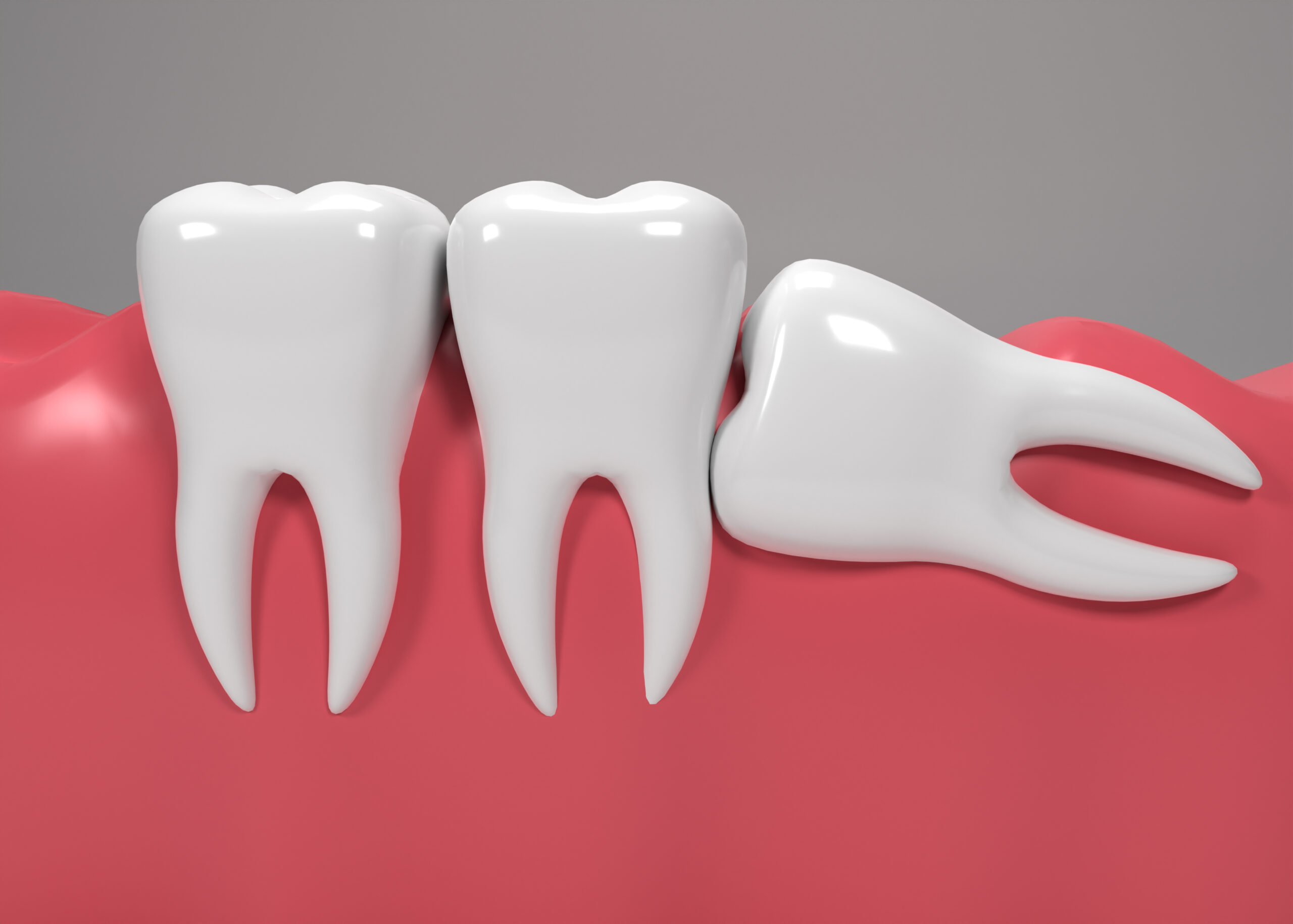 What Are Impacted Teeth? Understanding Causes, Symptoms, Diagnosis, and Treatment