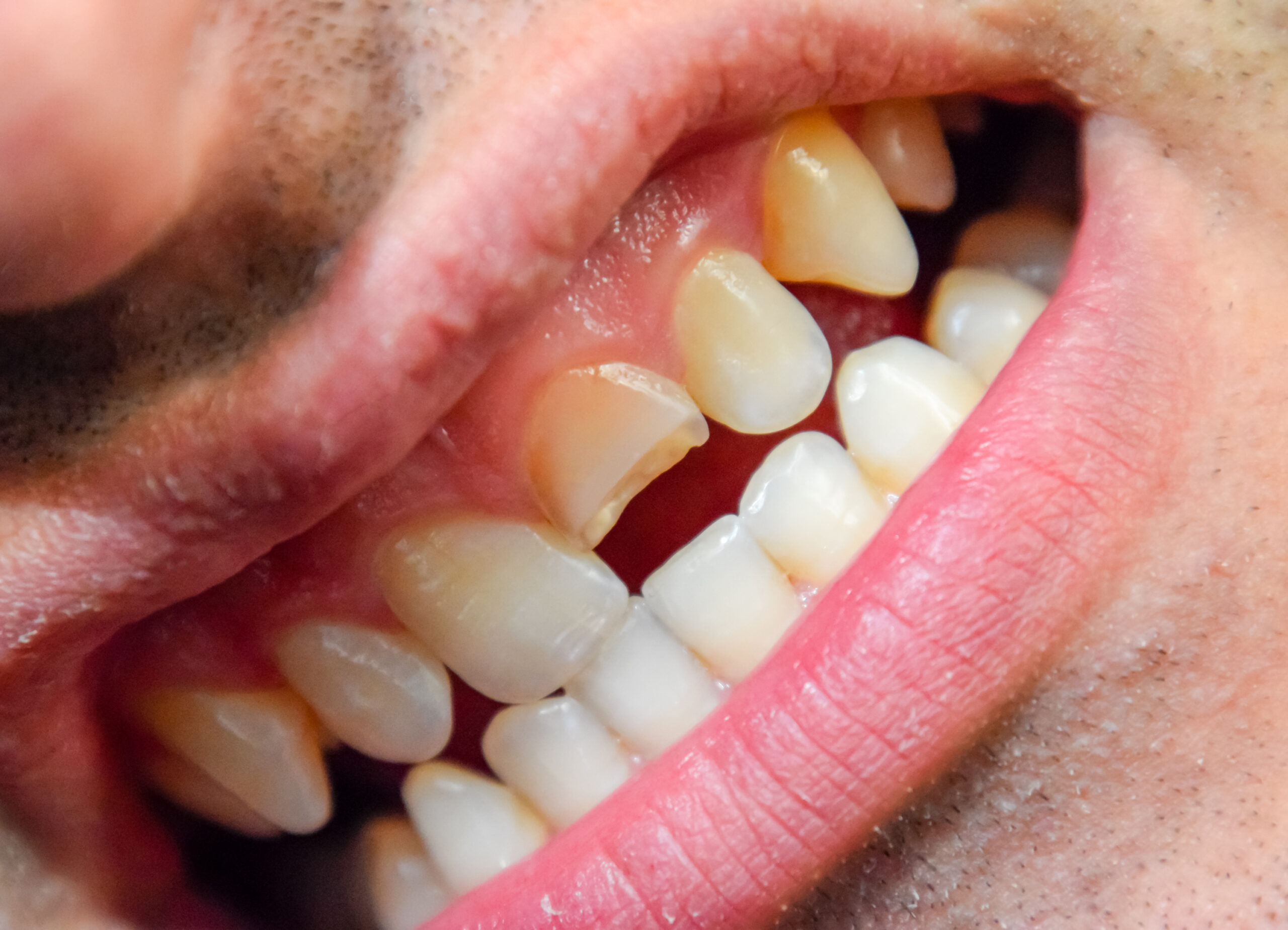 When to See a Dentist for a Tooth Fracture: Symptoms, Diagnosis, and Treatment