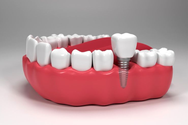 Dental implants clinic