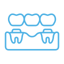 Dental Bridges